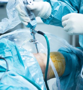 Arthroscopy