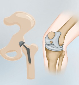 Joint Replacement